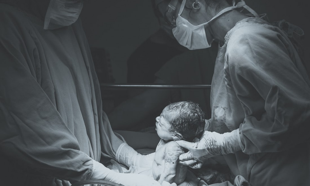 Birth in Gabon of a baby without a nose, only one eye and Two S£XES