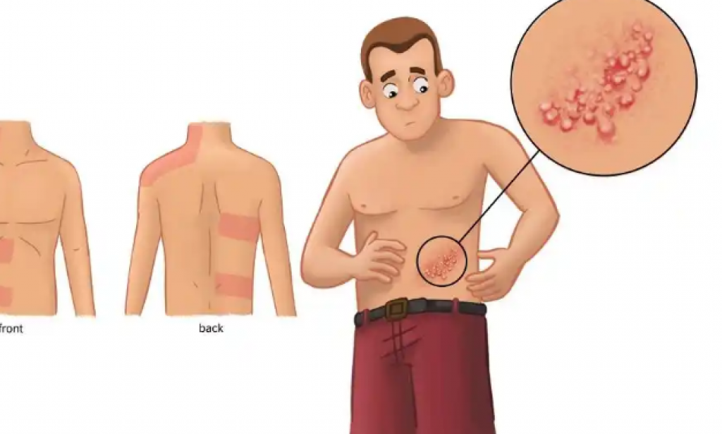 Shingles in the Mouth