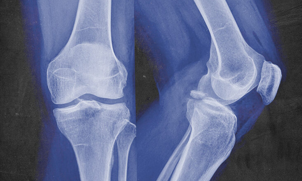 Eat this to prevent bone damage