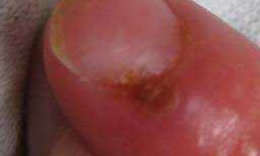 Everything you need to know about whitlow and its treatment