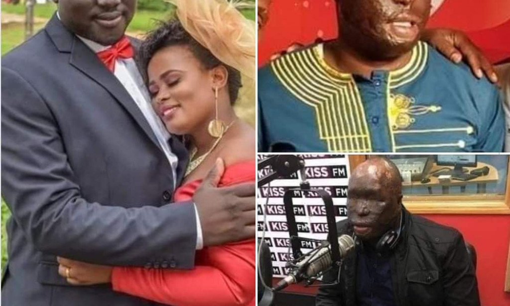 Hope Lost : Wife poured acid on her husband's face after household's Argument