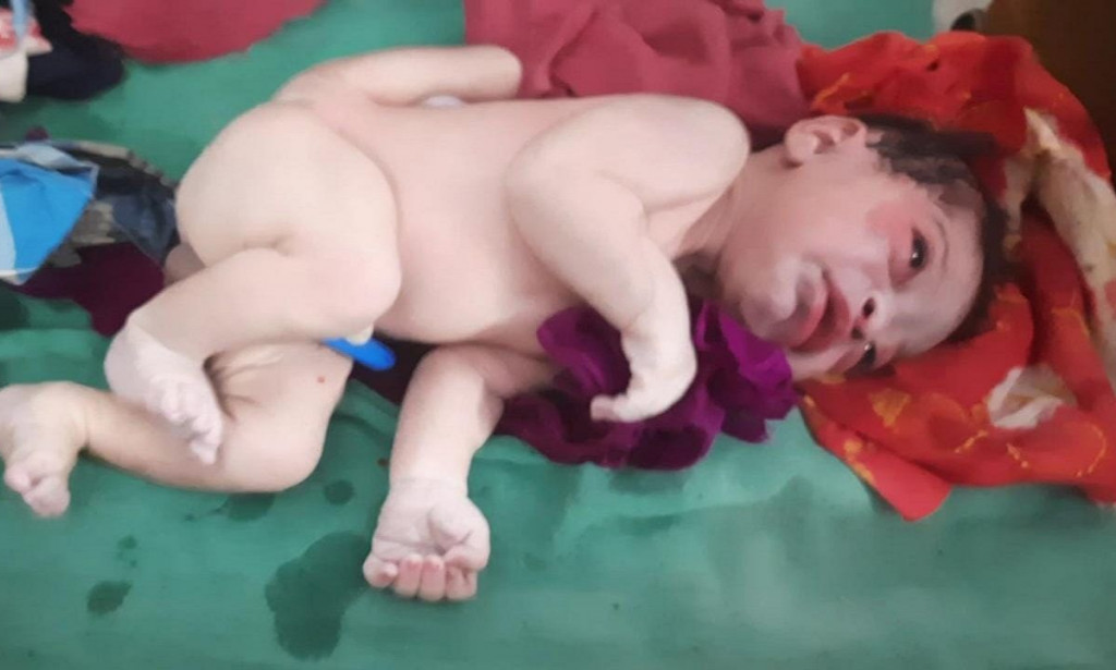 Reaction As A Baby Born with extra set of Arms and leg