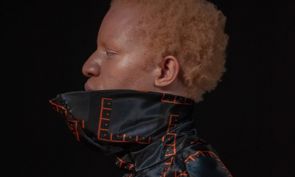 Lisette Azeugo ask: will albinos leave in peace in cameroon one day ?