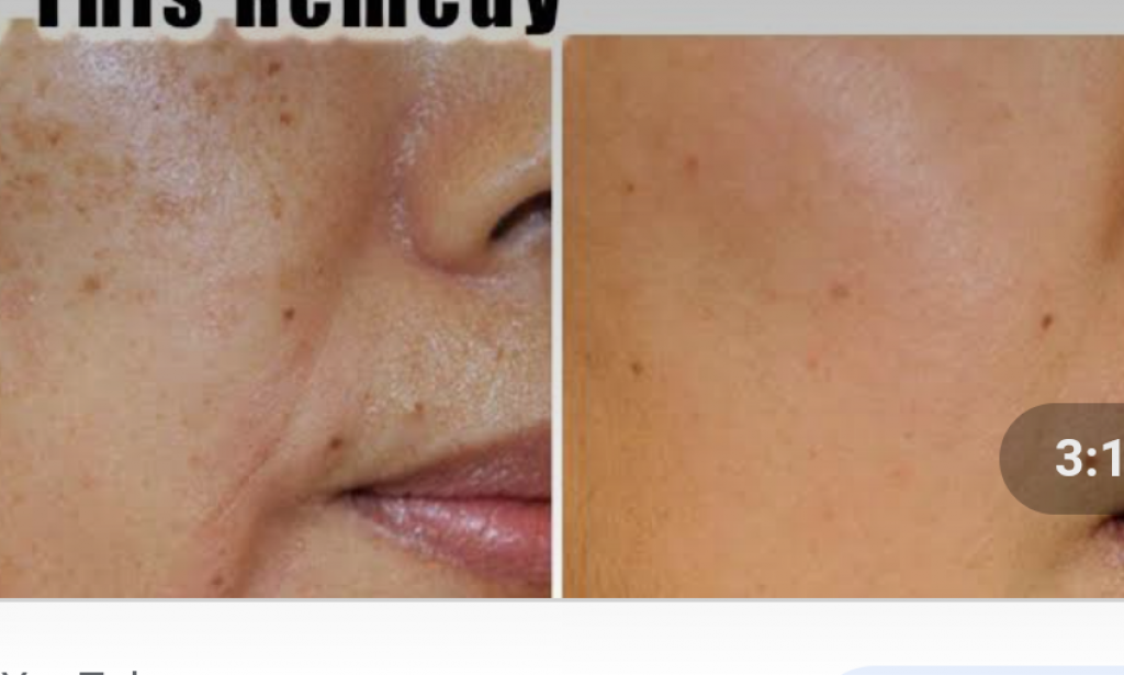 Remove stubborn freckles