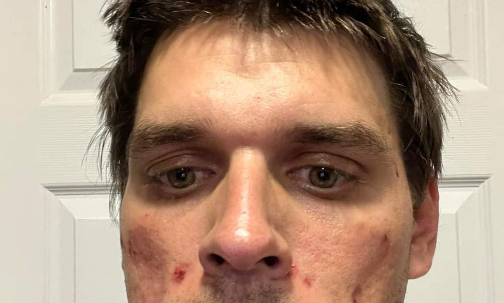 MonkeyPox : "I feel like I have this" Man Cries out Over Strange Symptoms