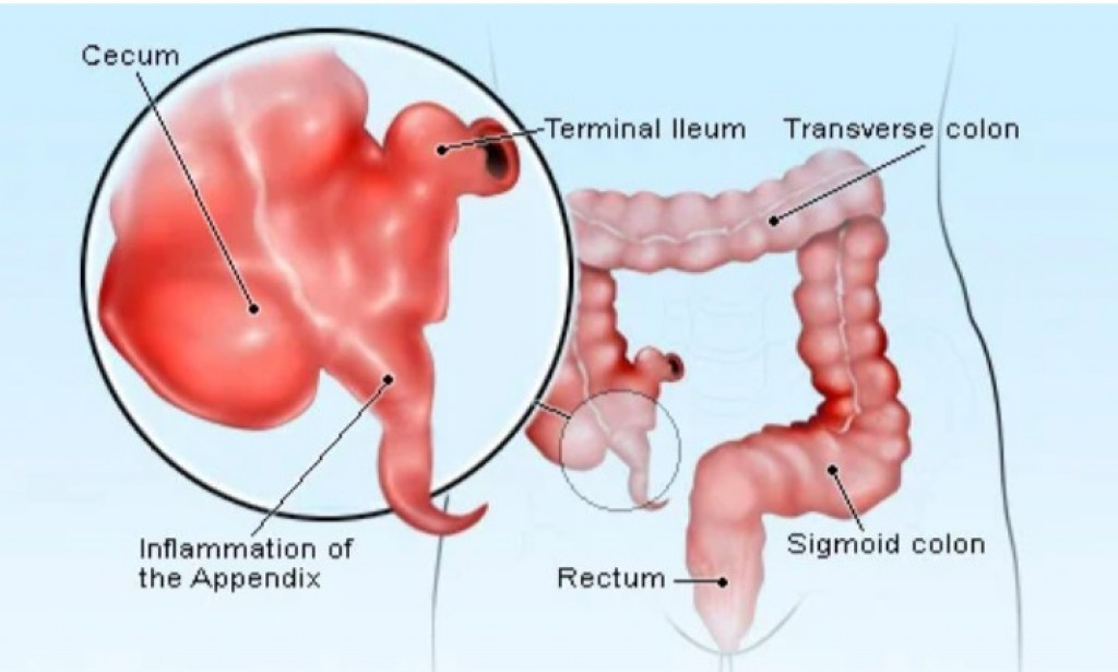 How to manage appendix