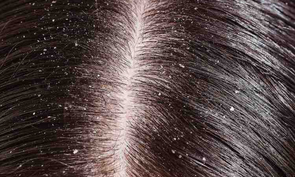 DANDRUFF HAIR FOR HAIR EXTENSIONS