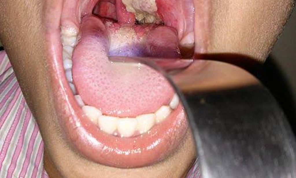 557 Cases Recorded And 73 Deaths Of Diptheria In Nigeria