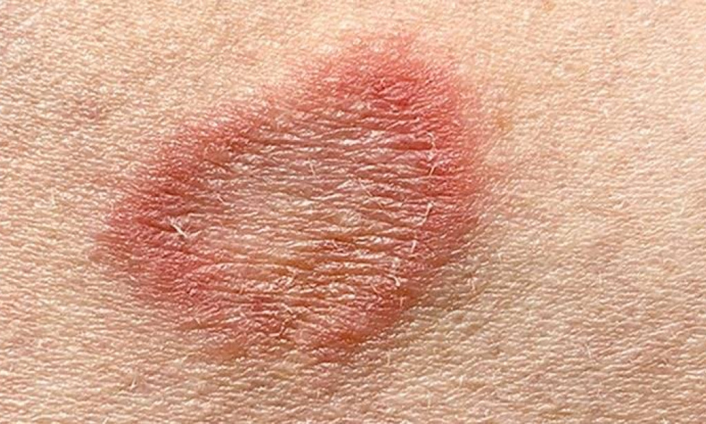 How is ringworm treated?