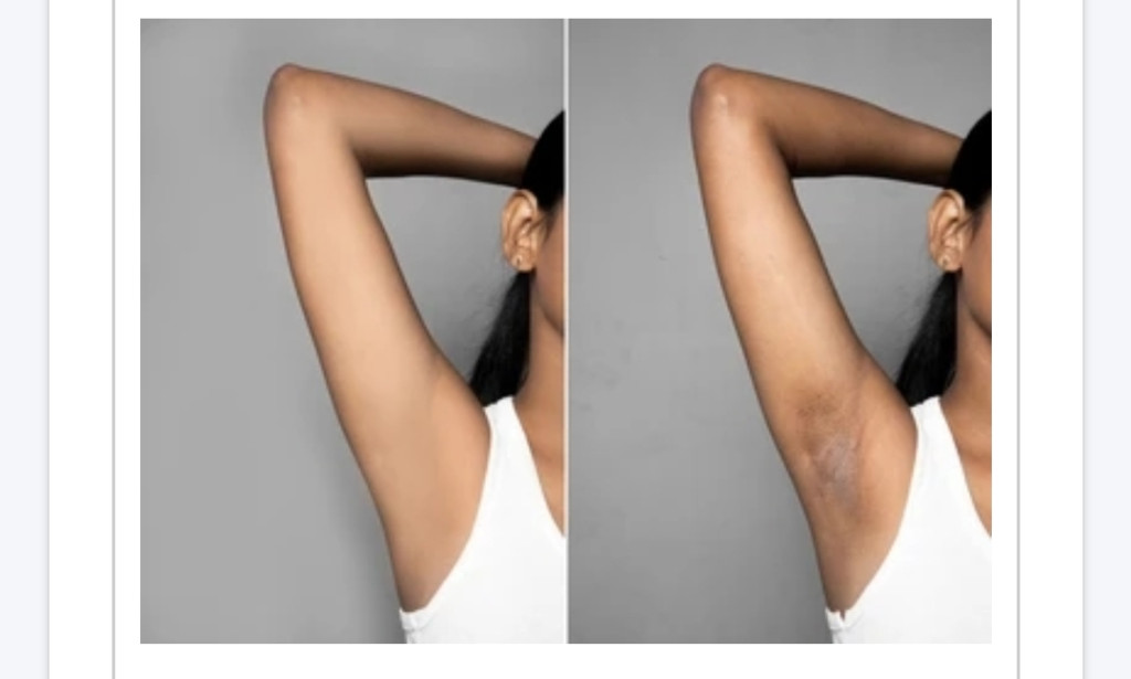 How to get rid of dark armpits in less than a week