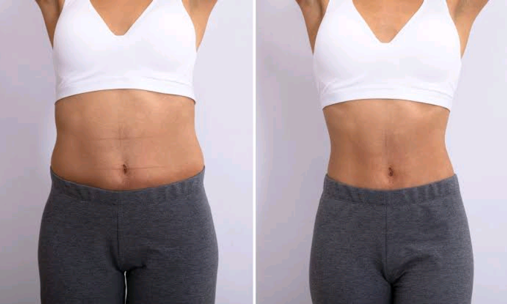 How to Get a Flat Stomach: 14 All-Natural Hacks for a Toned Ib