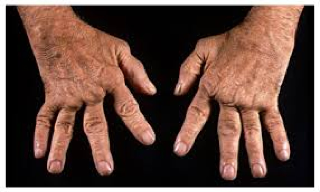 Understanding Autoimmune Diseases