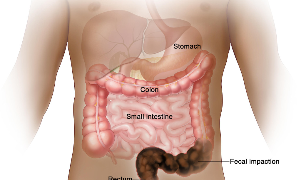How To Treat Constipation